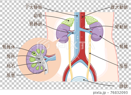 Illustration of kidney, ureter, bladder, kidney stone (with text) 76832093