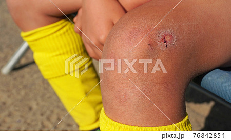 少年サッカーの試合で膝を怪我した子供の足 76842854