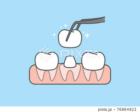 The white tooth is restored by the crown tooth. illustration vector design on blue background. Dental care concept. 76864923