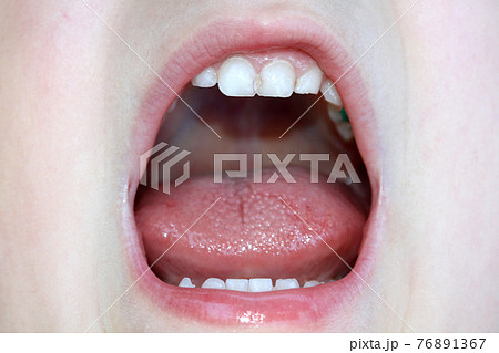 boy openning his moth 76891367