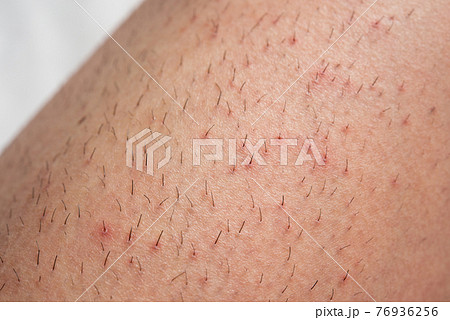 毛穴と肌荒れ　除毛1週間後のイメージ 76936256