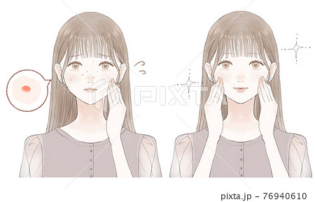 顔にできたニキビに悩む女性のビフォーアフターのイラスト素材