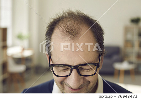 Closeup of top of head of cheerful balding mature man who needs hair loss treatment Closeup of top of head of cheerful balding mature man who needs hair loss treatment 76943473