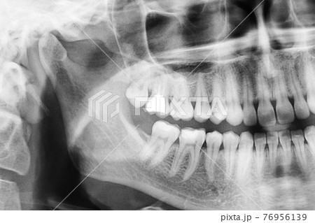Panoramic dental x-ray of oral cavity with teeth 76956139