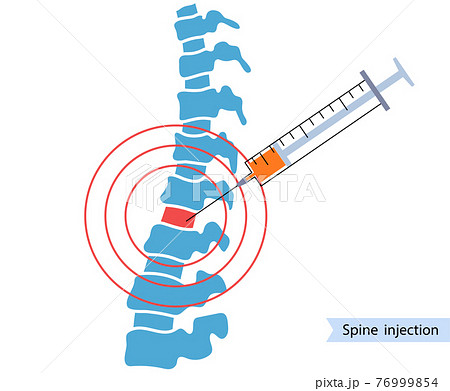 Spine joint injection  76999854