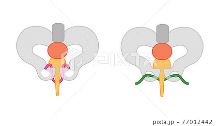 尿漏れ　TVT手術とTOT手術のメディカルイラスト素材 77012442