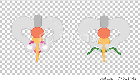 尿漏れ　TVT手術とTOT手術のメディカルイラスト素材 77012442