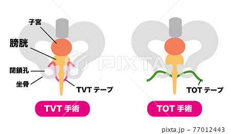 尿漏れ TVT手術とTOT手術のメディカルイラスト素材 尿漏れ TVT手術とTOT手術のメディカルイラスト素材 77012443