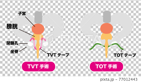 尿漏れ TVT手術とTOT手術のメディカルイラスト素材 尿漏れ TVT手術とTOT手術のメディカルイラスト素材 77012443