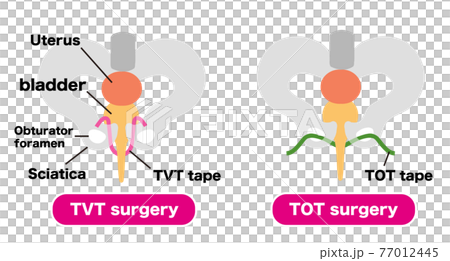 Urinary incontinence medical illustration material for TVT surgery and TOT surgery 77012445