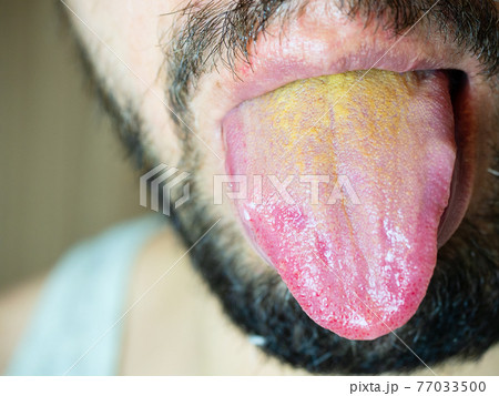 Male mouth with a protruding tongue with a yellow coating at the base 77033500