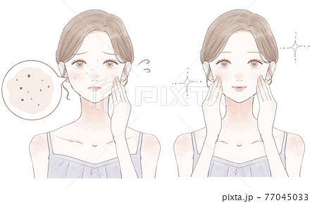 Before and after women suffering from darkened... - Stock Illustration  [77045033] - PIXTA