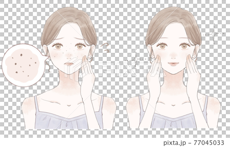 Before and after women suffering from darkened pores 77045033