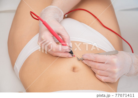 Woman on electro epilation on her tummy. Permanent hardware removal of unwanted abdominal hair. Woman on electro epilation on her tummy. Permanent hardware removal of unwanted abdominal hair. 77071411