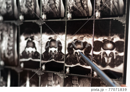 Doctor points on magnetic resonance imaging of the lumbar spine 77071839