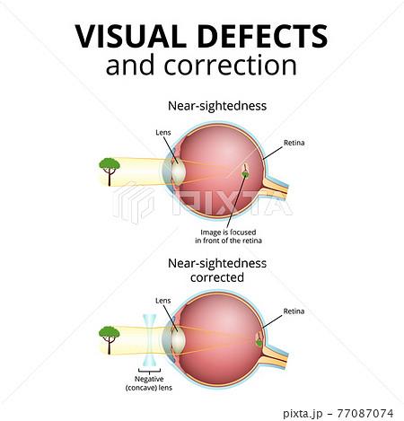 structure of the eyeball, visual impairment, near-sightedness structure of the eyeball, visual impairment, near-sightedness 77087074