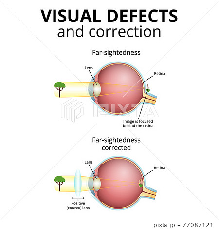 structure of the eyeball, visual impairment, farsightedness 77087121