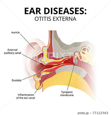 acute otitis externa, sectional image on white background 77122563