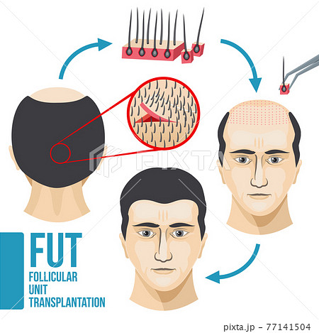 Male hair loss treatment medical infographic Male hair loss treatment medical infographic 77141504