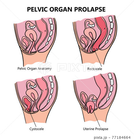 PELVIC ORGAN PROLAPSE VARIOUSLY Of Women General Diagram With Explanatory Text For Medical Education Clip Art Vector Illustration Set For Print PELVIC ORGAN PROLAPSE VARIOUSLY Of Women General Diagram With Explanatory Text For Medical Education Clip Art Vector Illustration Set For Print 77184664
