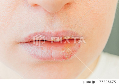 Close up of girl lips affected by herpes. Treatment of herpes infection and virus. Part of young woman face, lips with herpes affected. Beauty dermatology concept. Close up of girl lips affected by herpes. Treatment of herpes infection and virus. Part of young woman face, lips with herpes affected. Beauty dermatology concept. 77208675