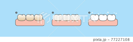Step of whitening teeth by teeth whitening strips. illustration vector design on blue background. Dental care concept. 77227108