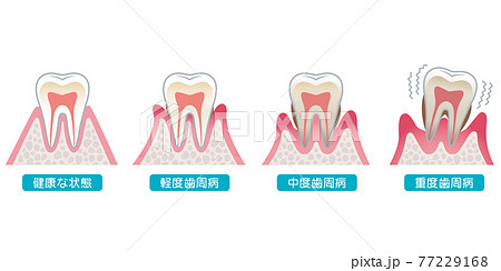 歯周病の進行 医療のイラスト素材