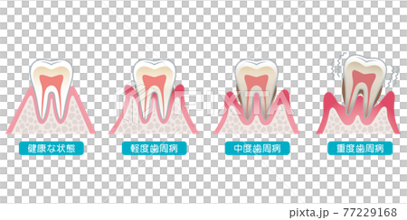 歯周病の進行　医療 77229168