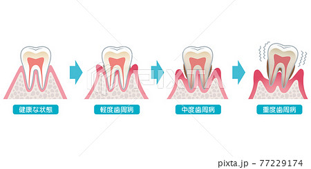 歯周病の進行 医療のイラスト素材
