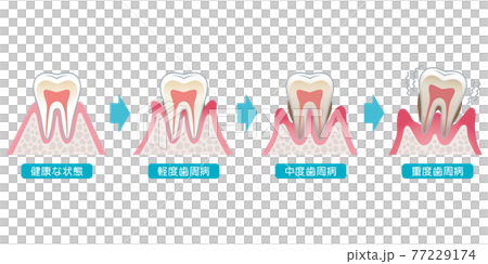 歯周病の進行　医療 77229174