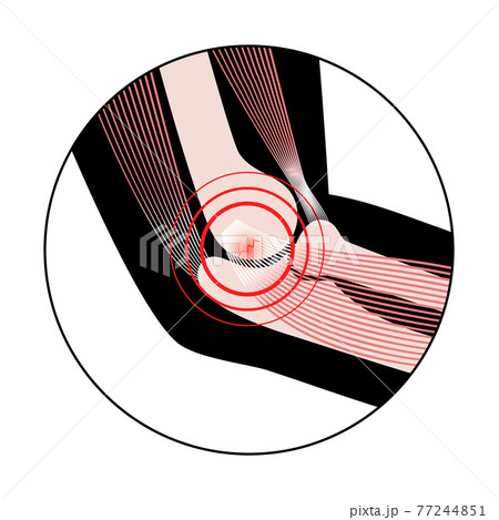 Medial epicondylitis golfer elbow Medial epicondylitis golfer elbow 77244851
