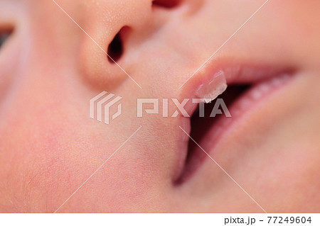 吸いだこの皮が剥けた新生児の唇 77249604