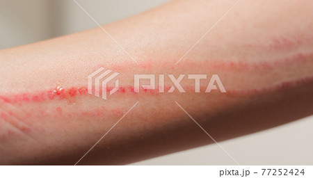 Apply ointment on forearm 77252424