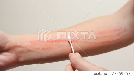 Apply ointment on forearm 77259258