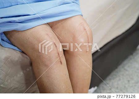 Asian senior or elderly old lady woman patient show her scars surgical total knee joint replacement Suture wound surgery arthroplasty on bed in nursing hospital ward Asian senior or elderly old lady woman patient show her scars surgical total knee joint replacement Suture wound surgery arthroplasty on bed in nursing hospital ward 77279126