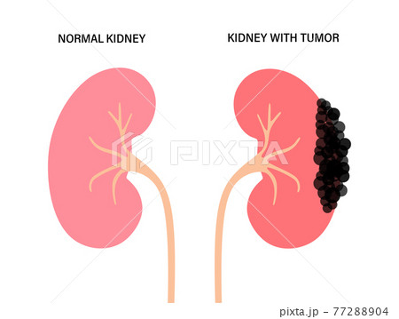 Kidney disease concept 77288904