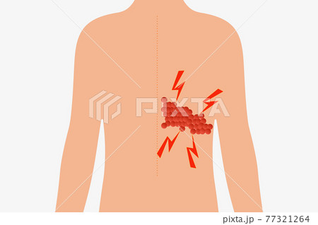 帯状疱疹 帯状疱疹 77321264