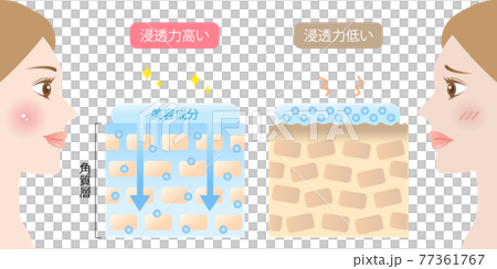 高滲透性皮膚和低滲透性皮膚女性的橫斷面圖 高滲透性皮膚和低滲透性皮膚女性的橫斷面圖 77361767