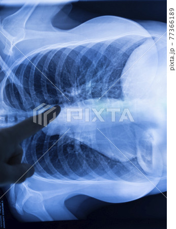 Lungs ribs xray scan 77366189