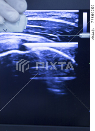EPI dry needling ultrasound scan EPI dry needling ultrasound scan 77366209