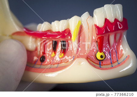 Tooth decay dental model Tooth decay dental model 77366210
