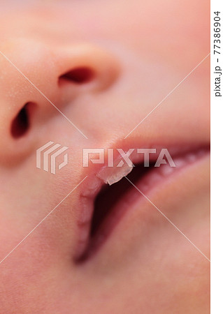 吸いだこの皮が剥けた新生児の唇 吸いだこの皮が剥けた新生児の唇 77386904