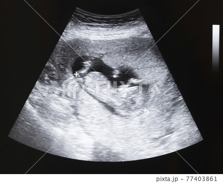Ultrasound of baby in pregnant woman Ultrasound of baby in pregnant woman 77403861