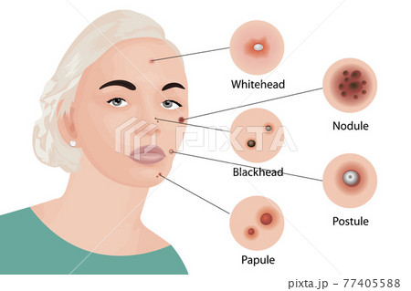 Acne types vector illustration. Cosmetology 77405588