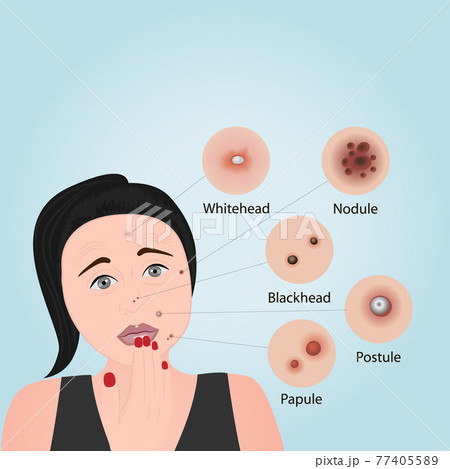 Acne types on a face vector illustration. Cosmetology 77405589