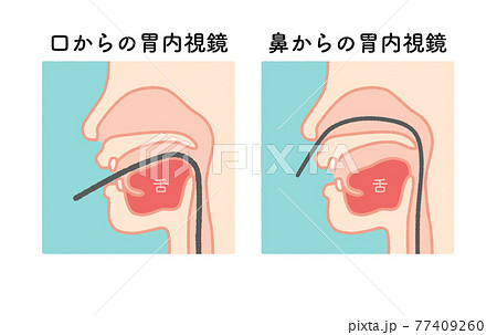 内視鏡 図解 イラスト 文字なし 77409260