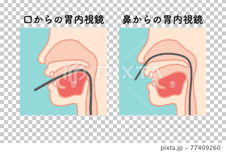 内視鏡 図解 イラスト 文字なし 77409260