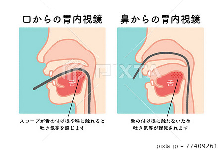 胃内視鏡 図解 イラスト 胃内視鏡 図解 イラスト 77409261