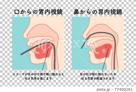 胃内視鏡 図解 イラスト 胃内視鏡 図解 イラスト 77409261