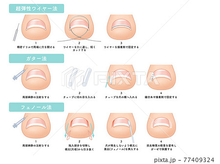巻き爪 陥入爪 ガター法 フェノール法 ワイヤー法 イラスト  77409324